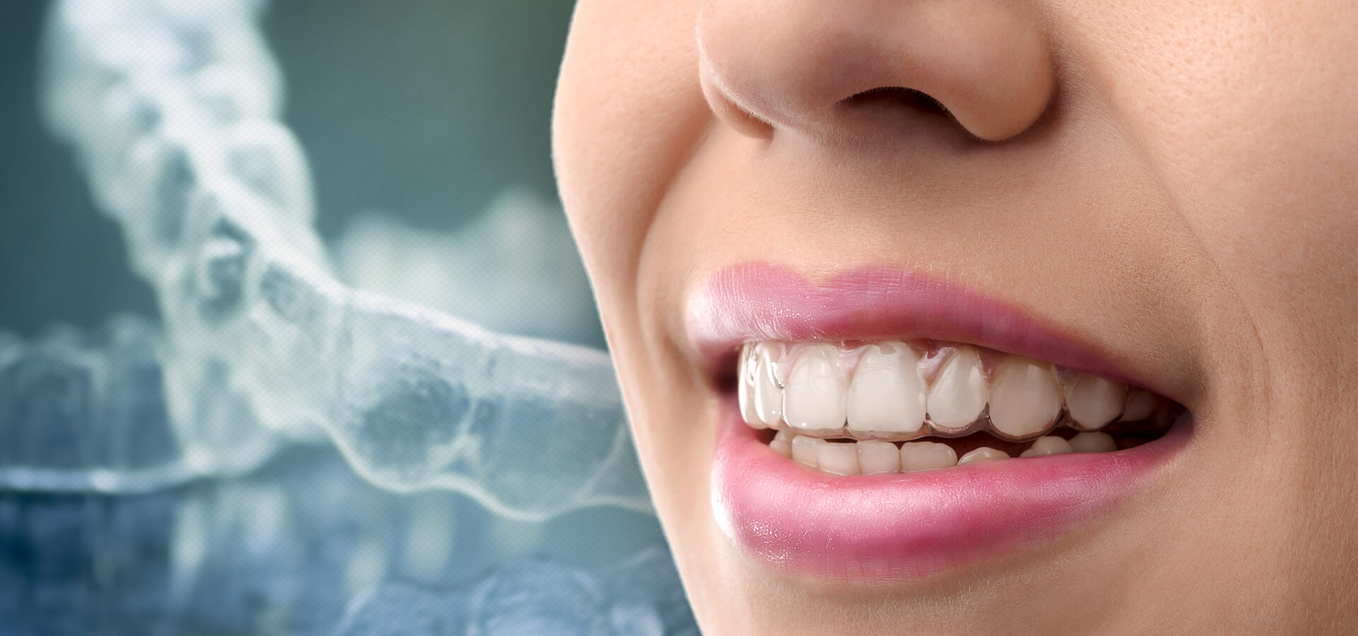 Close-up on Woman's Teeth in Invisalign Clear Aligners