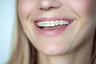 Ceramic braces up close