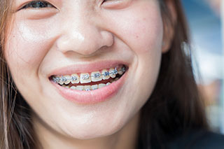 Metal braces up close