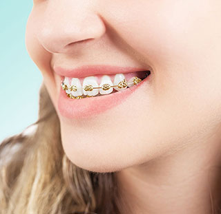 Gold braces